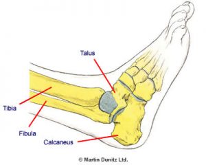 Prevention & Treatment of a Broken Ankle | PhysioRoom Injury Advice