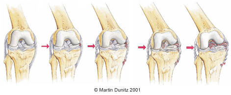 MCL Tear or Medial Collateral Ligament Injuries
