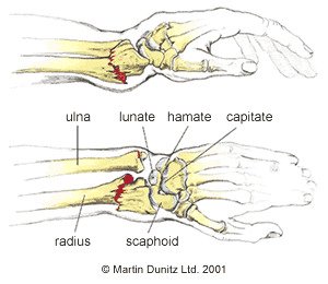 https://www.physioroom.com/advice/wp-content/uploads/2021/05/colles-fracture.jpg