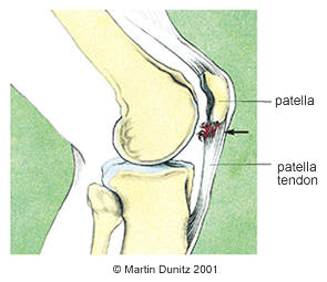plantar tendonitis knee