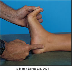 Tibialis Posterior Pain Acquired Flat Foot In Depth